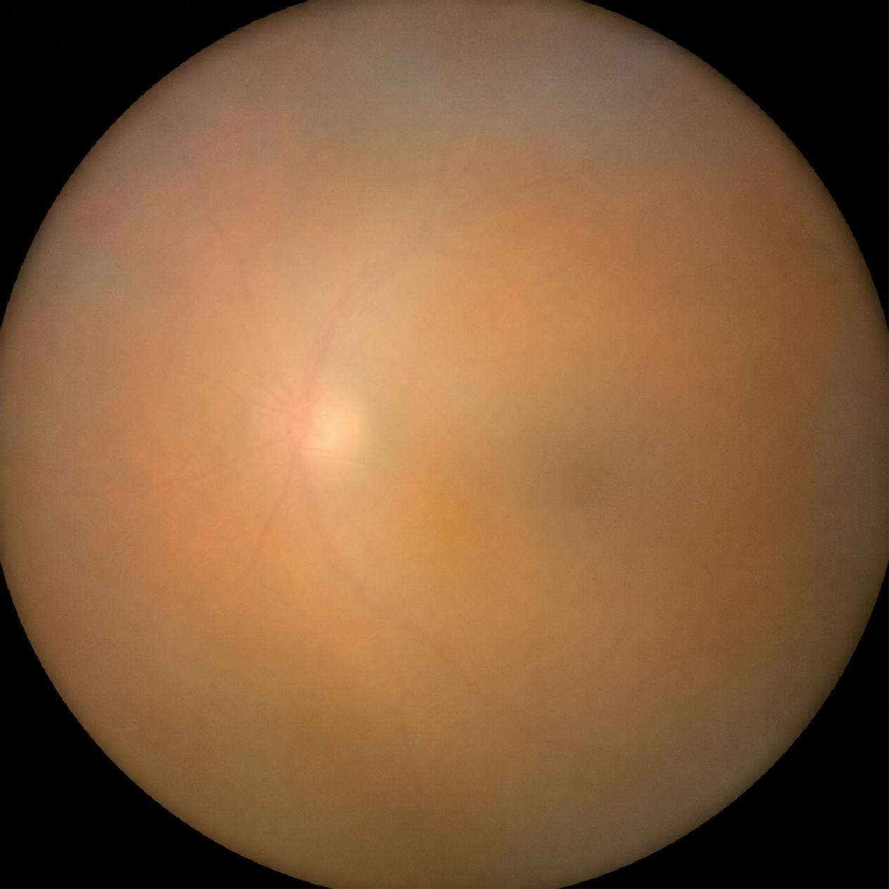 Cataracts