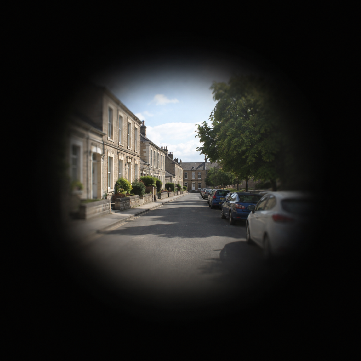Macular Degeneration (AMD)